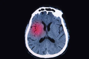 A concussion is a mild Image